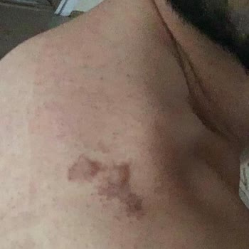 Glory Güzellik Merkezinde Lazer Epilasyonda Bitiş Garantisi İhlali Ve Yanık Olayı