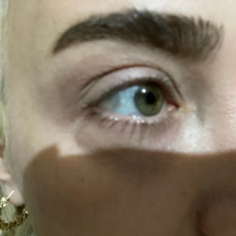 Mezoterapi Sonrası Görme Bozukluğu Ve İade Talebi