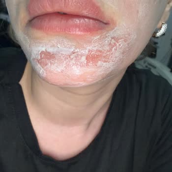 Şiddetli Yanık Ve Kızarıklığa Neden Olan Sesu Tüy Sarartıcı Ürünü