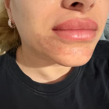 Şiddetli Yanık Ve Kızarıklığa Neden Olan Sesu Tüy Sarartıcı Ürünü