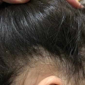 Ecowell Bebek Şampuanı Saç Derisinde Şiddetli Kaşıntı Ve Pul Dökülmesine Sebep Oluyor
