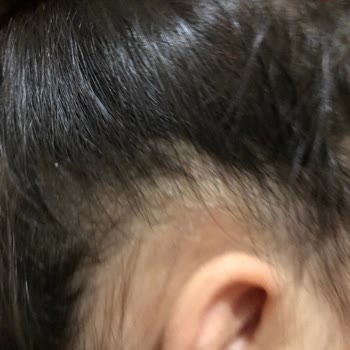 Ecowell Bebek Şampuanı Saç Derisinde Şiddetli Kaşıntı Ve Pul Dökülmesine Sebep Oluyor