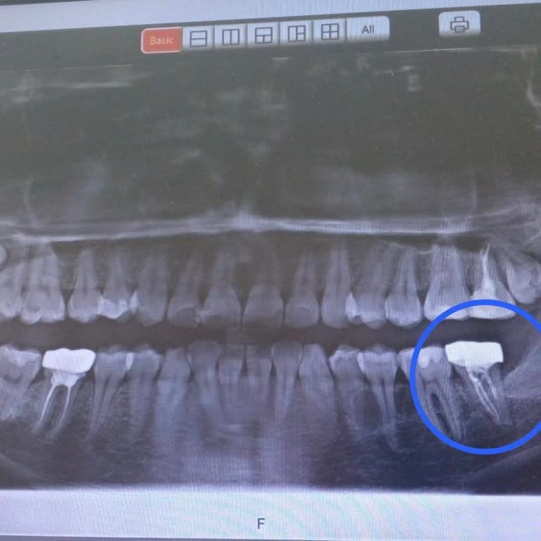 Moss Dental Hatalı Kanal Tedavisi Ve Kalıcı Kaplama Sonrası Şiddetli Diş Ağrısı