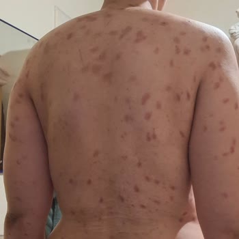 Lazer Cihazı Yanması Ve Sağlık Sorunları Nedeniyle Ürün Bedelinin İadesi