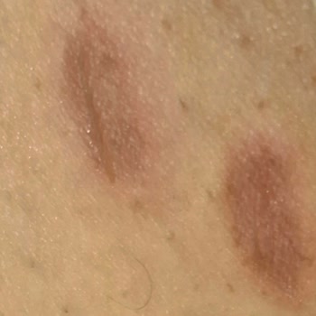 Lazer Cihazı Yanması Ve Sağlık Sorunları Nedeniyle Ürün Bedelinin İadesi