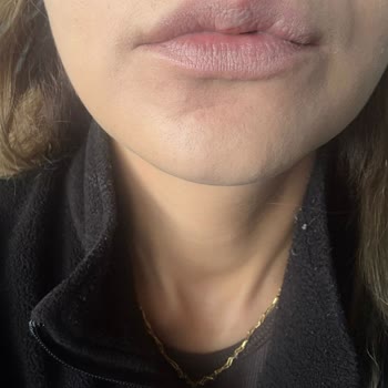 Dudak Renklendirme Sonrası Şiddetli Acı Ve Bozulmuş Şekil