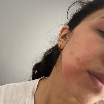 L’Loreal Paris Retinal Serumu Yüzümde Birinci Derece Yanıklara Neden Oldu