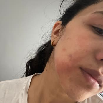 L’Loreal Paris Retinal Serumu Yüzümde Birinci Derece Yanıklara Neden Oldu