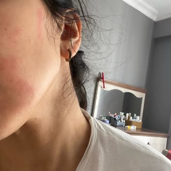 L’Loreal Paris Retinal Serumu Yüzümde Birinci Derece Yanıklara Neden Oldu