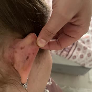 Saç Açma İşleminde Yanık Ve Kötü Hizmet Nedeniyle 5.000 TL İadesi Talebi