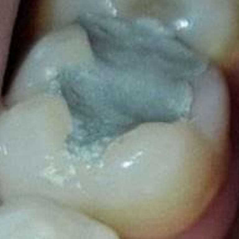 Amalgam Dolgu İçin Bilgilendirme Eksikliği Ve Doktorun Kaba Tutumu