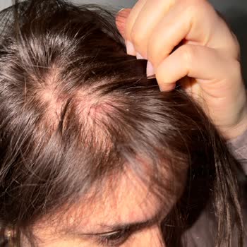 Saç Kaynağı Sonrası Ağrı Ve Saç Seyrekleşmesi Nedeniyle 45.000 TL Ücretin İadesi