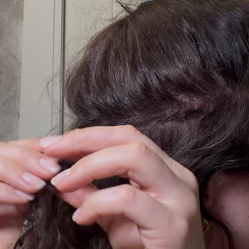 Saç Kaynağı Sonrası Ağrı Ve Saç Seyrekleşmesi Nedeniyle 45.000 TL Ücretin İadesi