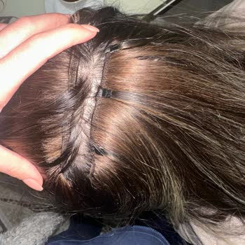 Rönesans Peruka’da Hatalı Kaynak Ve Boncuklar Nedeniyle Saçta Ağrı Ve Telafi Talebi
