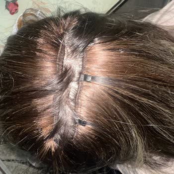Rönesans Peruka’da Hatalı Kaynak Ve Boncuklar Nedeniyle Saçta Ağrı Ve Telafi Talebi