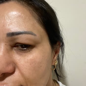 Botoks Ve Dolgular Etkisiz, Göz Kapağı Düşüklüğü Nedeniyle İade Talebi