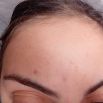 Ürün Kullanımı Sonrası Sivilce Artışı
