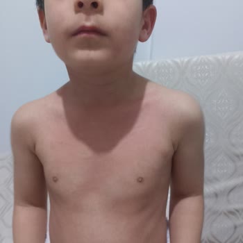 BİM Şubesinde Son Kullanma Tarihi Yakın Ürün Satışı Çocuğumda Alerjik Kriz