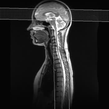 Aksigorta’nın Önceden Var Olan Hastalık Gerekçesiyle Fizik Tedavi Provizyonumun Reddedilmesi