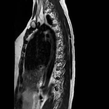 Aksigorta’nın Önceden Var Olan Hastalık Gerekçesiyle Fizik Tedavi Provizyonumun Reddedilmesi