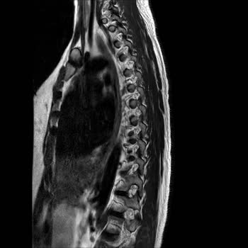 Aksigorta’nın Önceden Var Olan Hastalık Gerekçesiyle Fizik Tedavi Provizyonumun Reddedilmesi