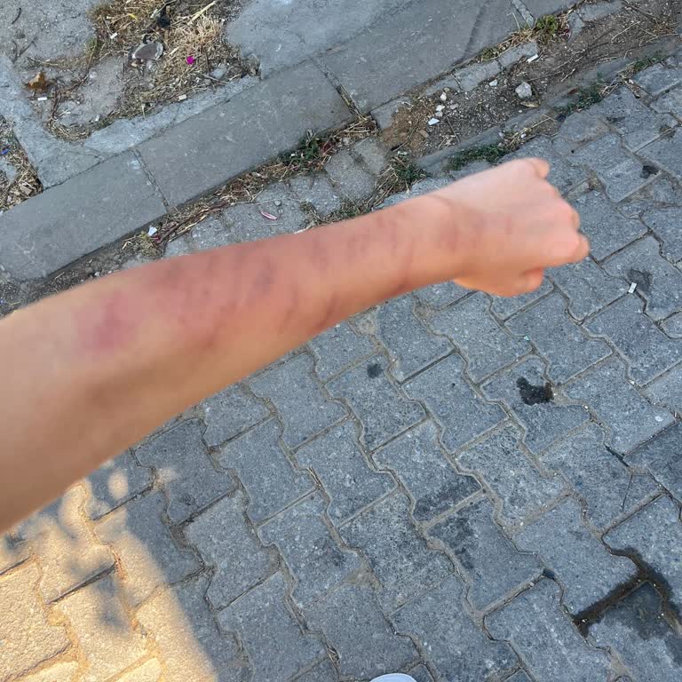 Aris Güzellik Merkezleri Lazer Epilasyon Sonrası Şiddetli Yanık ve Cevapsızlık