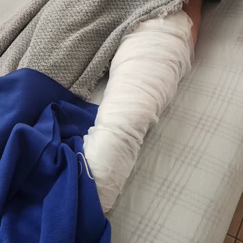 Vestel Cam Çay Demliği Tutacağı Kırıldı, 2. Derece Yanık