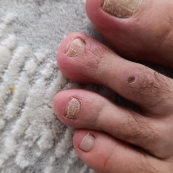 Ayakkabı Ayak Vurması Ve Yara Oluşturması Nedeniyle İade Talebi Reddi
