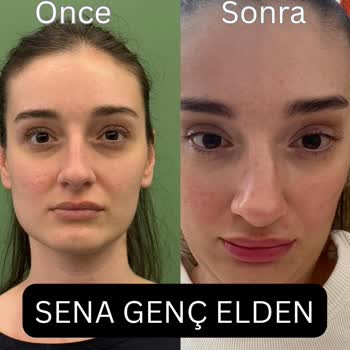 Doktorun İptal İsteğime Rağmen Operasyonu Sürdürmesi Ve Burun Şekil Bozukluğu