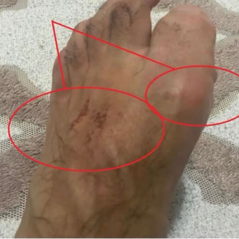 Ayıplı Ayakkabı Ve Ayak Yaralanması İçin Hızlı Çözüm Talebi