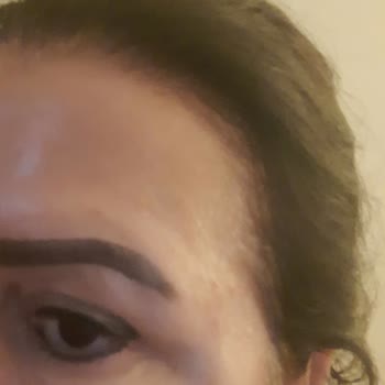 Botoks Sonrası Şiddetli Şişlik Ve Asimetri İçin Tıbbi Düzeltme Talebi