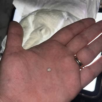 Molfix Bebek Bezinde Taş Benzeri Cisim Çıktı, Sağlık Tehlikesi