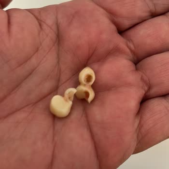 Üst İmplant Kaplamam Kırıldı, Ücretsiz Garanti Onarımı Ve İletişimsizlik Şikayetim