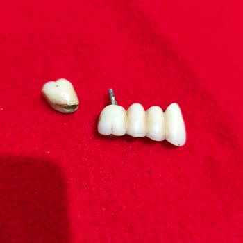 Başarısız Üst Çene İmplant Tedavisi Ve Tekrarlayan Kaplama Düşmeler