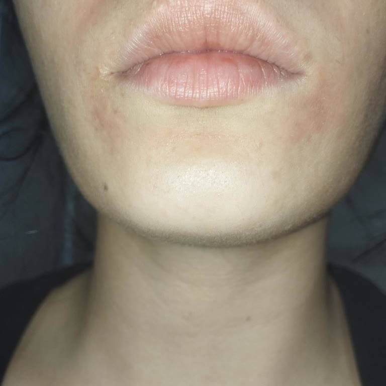 Neutrogena Yüz Temizleme Jelinde Şiddetli Yanma, Pul Dökülme Ve Leke Oluşumu