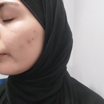 Yüzümde Sivilcelenme Ve Ürün İadesi Talebi