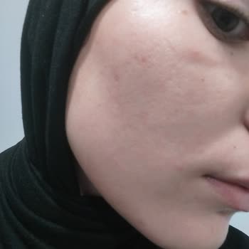 Yüzümde Sivilcelenme Ve Ürün İadesi Talebi