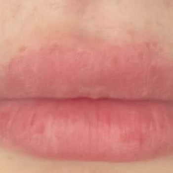 Kadıköy Klinik Pera 1 Yıllık Juvederm Dolgusu 9 Gün İçinde Eridi, İade Talebi Ve İletişim Engeli