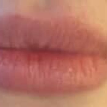 Kadıköy Klinik Pera 1 Yıllık Juvederm Dolgusu 9 Gün İçinde Eridi, İade Talebi Ve İletişim Engeli