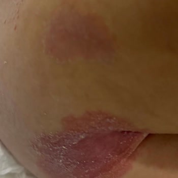 Molfix Bebek Bezinde Cilt Yanığı Ve Koyu Lekeler