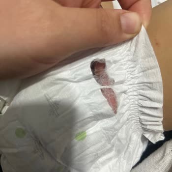 Sleepy Bebek Bezinde Yırtıklar Ve Şiddetli Sızıntı, Telafi Talebi