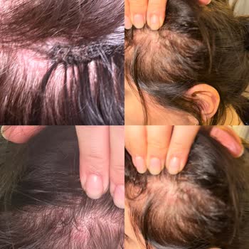 Saç Kaynak İşlemi Sonrası Alerjik Dermatit Ve Saç Dökülmesi Nedeniyle 45.000 TL İade Talebi