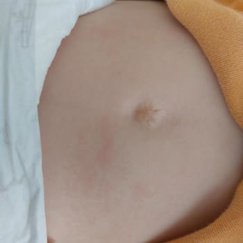 Hipp Organik Mama Kullanımında Şiddetli Alerjik Reaksiyon