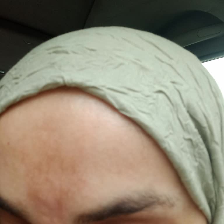 İşlevsiz Lazer Tedavisi Ve Yüz Lekesi Nedeniyle Tam Ücret İadesi Talebi