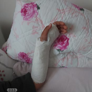 Kırığın Yanlış Tedavisi Çocuğumu Ağır Acıya Sürükledi Ve Hastane İncelemesi Talep Ediyorum