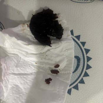 Çekirdeksiz Olması Gereken Kuru Erikte Büyük Çekirdek Ve Diş Kırığı Riski