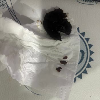 Çekirdeksiz Olması Gereken Kuru Erikte Büyük Çekirdek Ve Diş Kırığı Riski