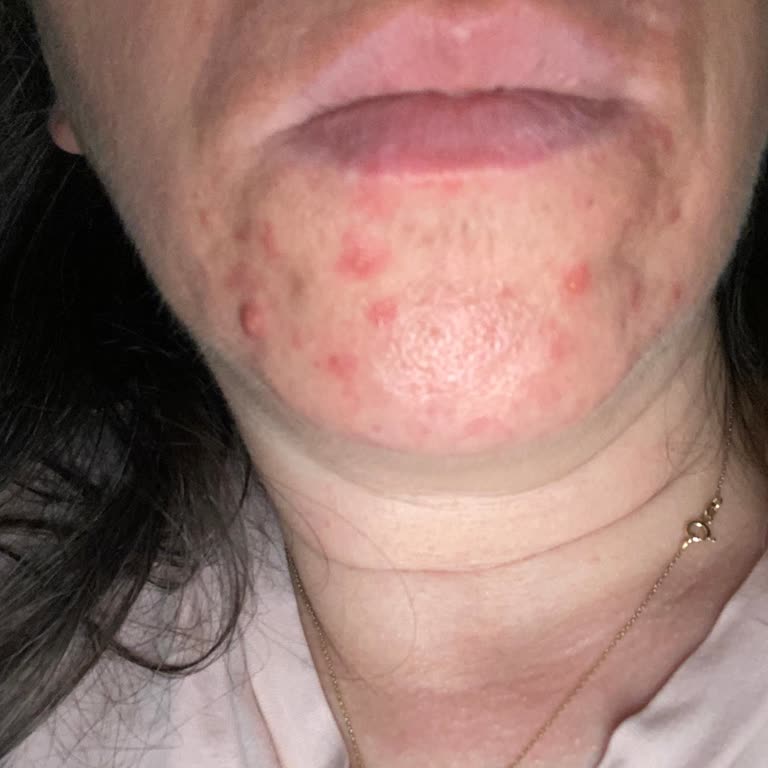 C Vitamini Kremi Kullanımından Sonra Şiddetli Sivilce Ve Cilt Hasarı