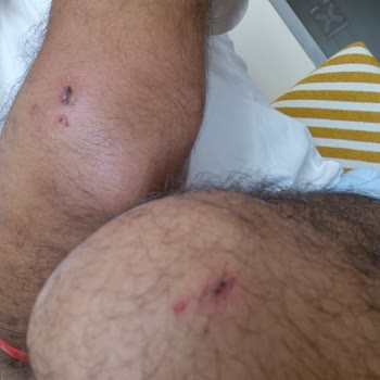 The X Belek Otelinde Roket Kaydırak Kazası Ve Yetersiz Müşteri Desteği