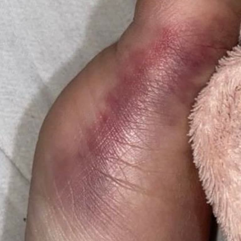 Ayakkabının Kenarlarından Gelen Keskinlik Nedeniyle Sağlık Sorunu Ve İade Talebi